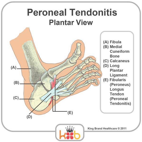 King Brand Peroneal Tendonitis Injury Treatment Plantar View Labelled Tendons and Bones Diagram