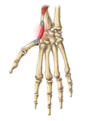 A drawing of a skeletal hand with inflammation due to a Repetitive Strain Injury