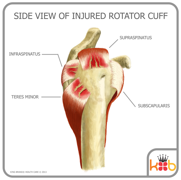 King Brand Shoulder Injury Rotator Cuff Side View Tendons and Tears
