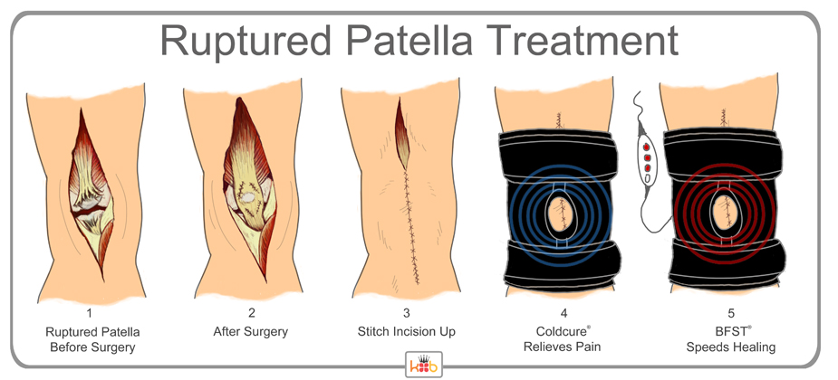 King Brand Ruptured Patella Treatment Explaination Diagram Image and Information