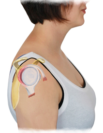 A Shoulder Labrum Injury Overlaid on a Person