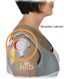 An Animation of a Shoulder Labrum Being Treated by a King Brand Side Shoulder BFST Wrap Overlaid on a Person