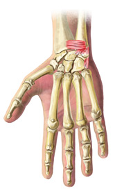 An illustration of a skeletal hand suffering from a Triangular Fibrocartilage injury