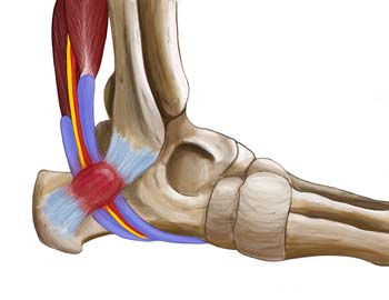 King Brand Side View of Ankle Injury Ligaments Tendons