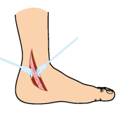 Ankle Tendon Cleaning Surgery