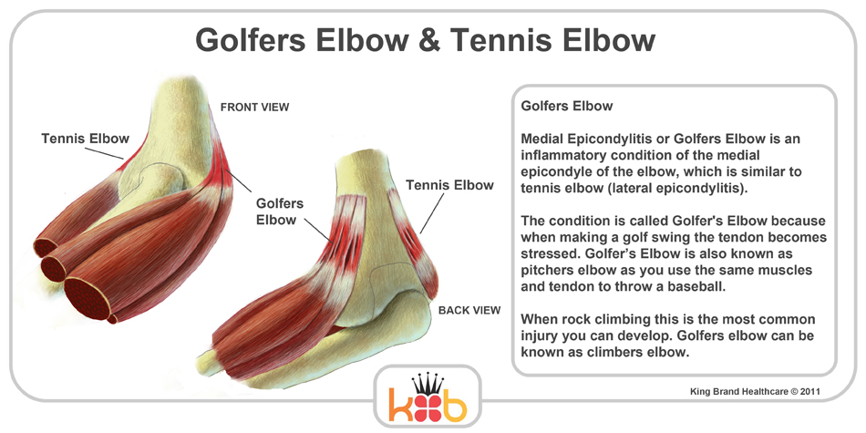King Brand Tennis Elbow Golfers Elbow Diagram Labelled Explaination