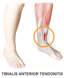 An Animation of the King Brand BFST Leg Wrap Treating Tibialis Anterior Tendonitis