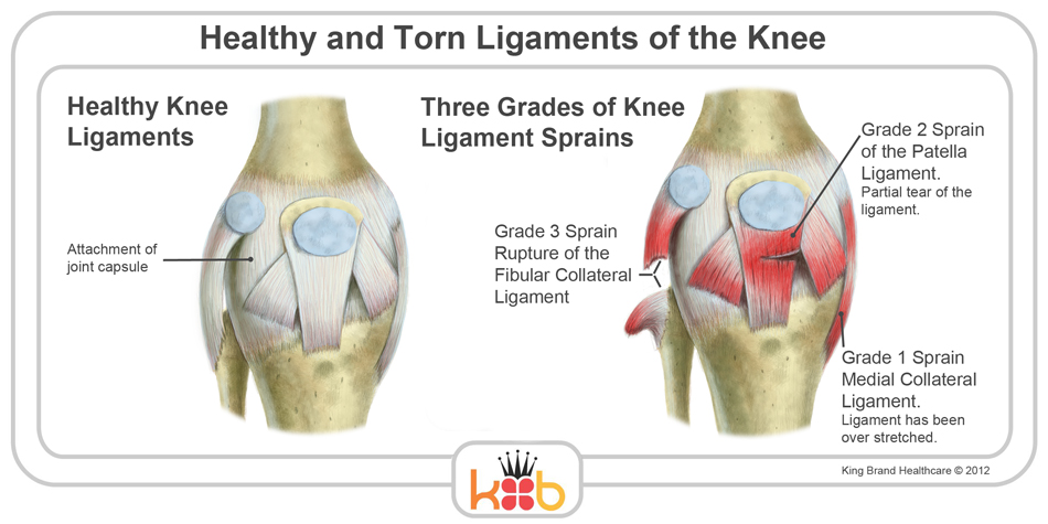 King Brand Knee Injury Image Diagram Ligaments Bones Muscle Labelled Diagram