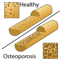 Diagram What is Osteoporosis