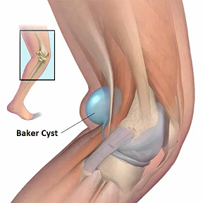 Baker's Cyst Information