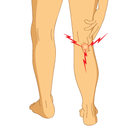 An Illustration of a Person Suffering from Bakers Cyst Pain